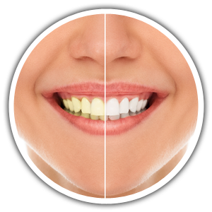 7 Things To Know About Teeth Whitening | Katy | Cinco Ranch