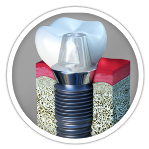 Dental Implants