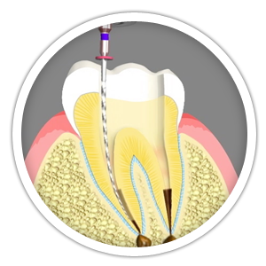 Root Canal Treatment