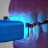 Teeth Whitening